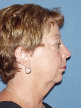 Chin Augmentation: Case 2 - Before