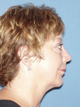 Chin Augmentation: Case 2 - After