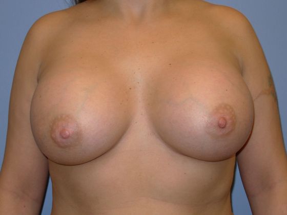 Breast Augmentation: Case 9 Breast Augmentation Frisco 450cc - After