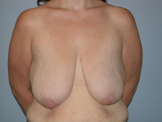 Breast Reduction Case 2 Breast Reduction - Before