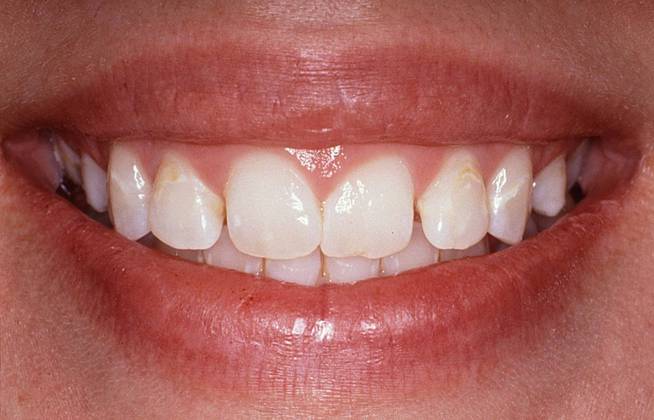 Porcelain Veneers Case 4 - Before