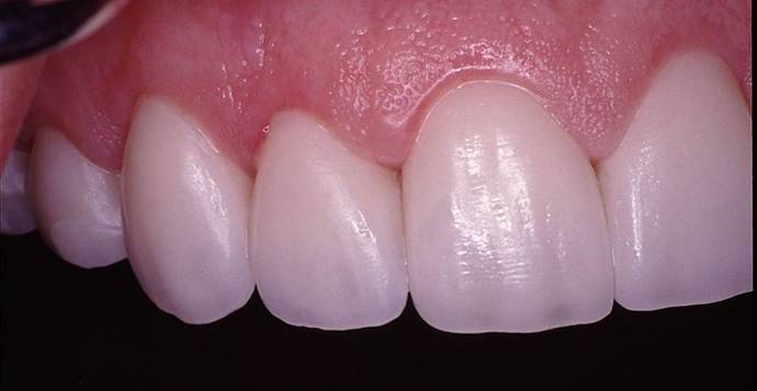 Porcelain Veneers: Case 4 - After Right Side View