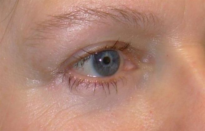 Eyelid Lift Case 3 Upper and Lower Eyelid Lift - After