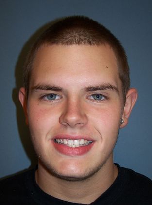 Deep Bite - Overlapping Teeth: Deep Bite Narrow Arch - After