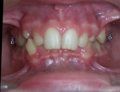 Deep Bite/Overlapping Teeth