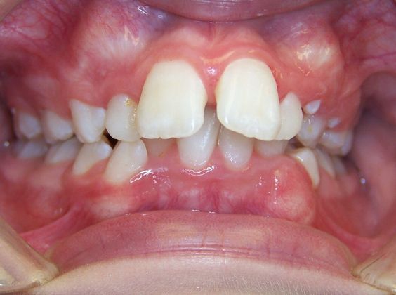 Deep Bite - Overlapping Teeth: Deep Bite and Narrow Arch - Before