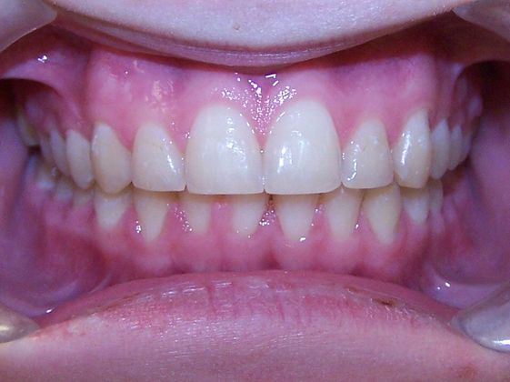 Deep Bite - Overlapping Teeth: Narrow Arch and Deep Bite - After