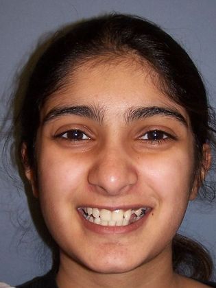 Deep Bite - Overlapping Teeth: Deep Bite - Before