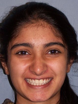 Deep Bite - Overlapping Teeth: Deep Bite - After