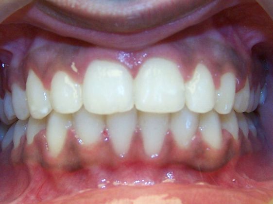 Deep Bite - Overlapping Teeth: Deep Bite - After