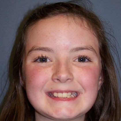 Deep Bite - Overlapping Teeth: Deep bite Squar Smile - Before