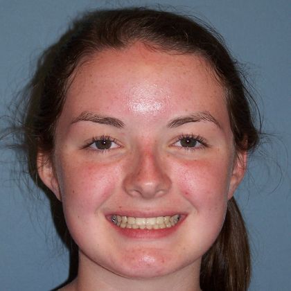 Deep Bite - Overlapping Teeth: Deep bite Squar Smile - After