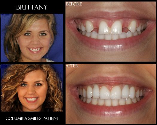 Veneers: Case 34 - Before