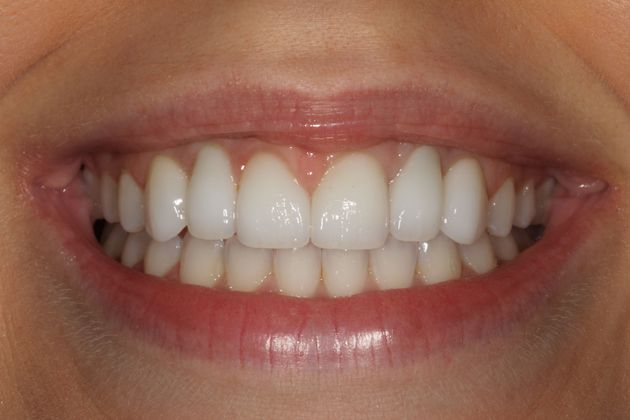 Veneers Case 34 - After