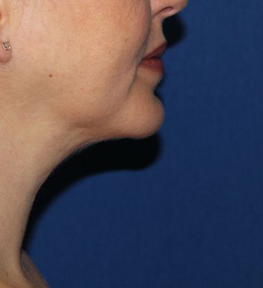 Neck Rejuvenation: Case 2 Neck Liposuction - After