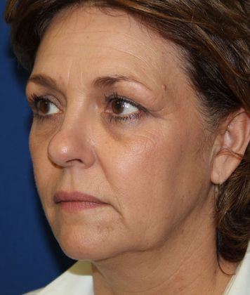 Facelift: Case 2 Facelift - Before