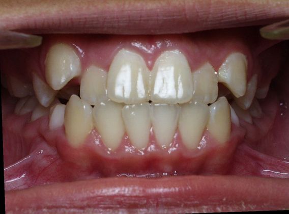 Amazing Smiles: Crowded Teeth and Anterior Cross Bite - Before