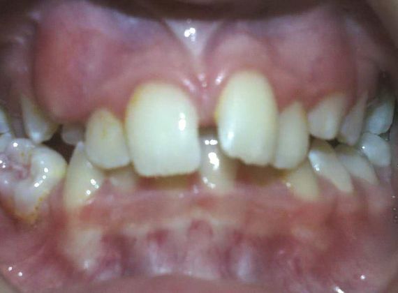 Amazing Smiles: Crowded and Over Bite - Before