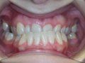 Missing Teeth and Braces
