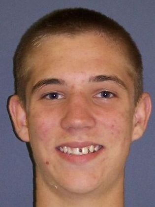 Missing Teeth : Missing Left Lateral - Before