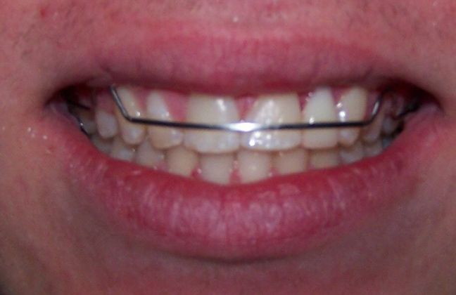 Missing Teeth : Missing Left Lateral - After