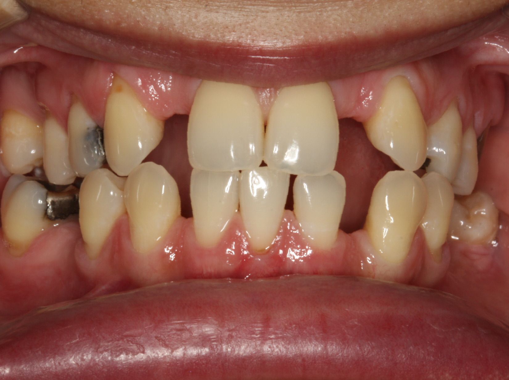 Missing Upper Laterals Missing Teeth and Braces Before