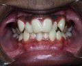  Crowding/Crooked Teeth