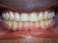 Invisalign/Invisible Braces