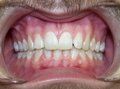 Invisalign/Invisible Braces