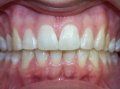 Invisalign/Invisible Braces