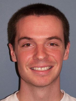 Invisalign - Invisible Braces: Midline Space - Before