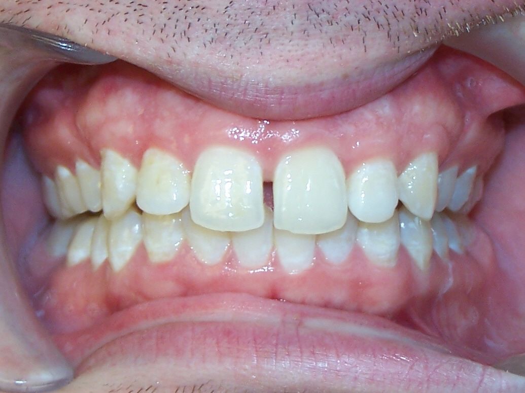 Midline Space Invisalign/Invisible Braces Before and After Gallery