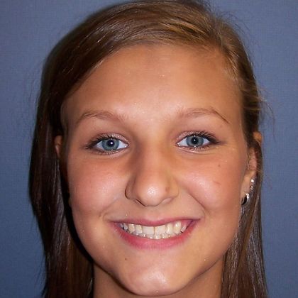 Open Bite Open bite on One Side - After