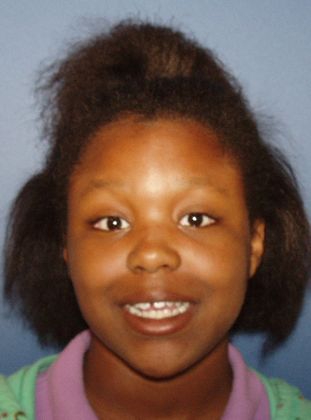 Open Bite Open bite and Spaces - Before