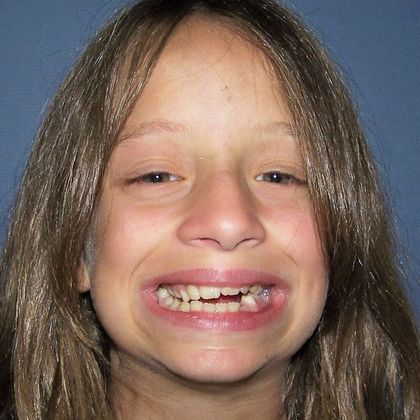 Open Bite Uneven Open Bite and Narrow Arch - Before