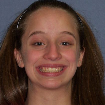 Open Bite Uneven Open Bite and Narrow Arch - After