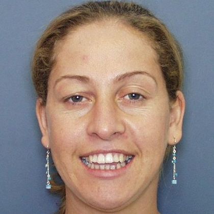 Open Bite: Adult Open Bite and Narrow Arch - Before