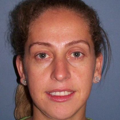 Open Bite: Adult Open Bite and Narrow Arch - After