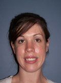 Orthognathic Surgery/Jaw Surgery