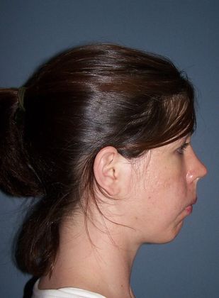 Orthognathic Surgery/Jaw Surgery: Crowding - Before