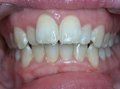 Orthognathic Surgery/Jaw Surgery