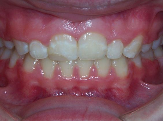 Over Bite/Over Jet Over Bite and Spaces - After