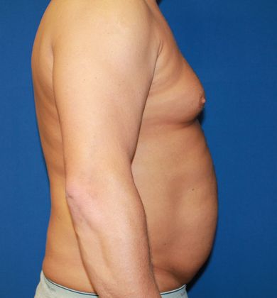 Male Body Contouring: Case 4 Male Liposuction Chest, Abdomen, Flanks - Before