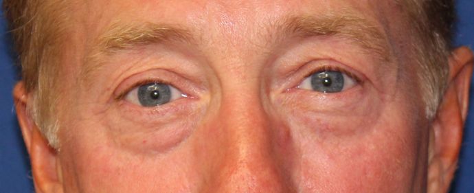 Eyelid Lift: Case 4 Upper and Lower Eyelid Lift - Before