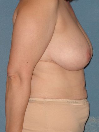 Liposuction: Case 2 - Before - Side View