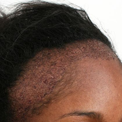 Hair Transplant - Female: Traction Alopecia FUT (3) - Before/Post-op