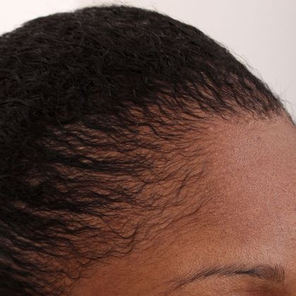 black female hair transplant - Female Before And After Hair Transplant ...