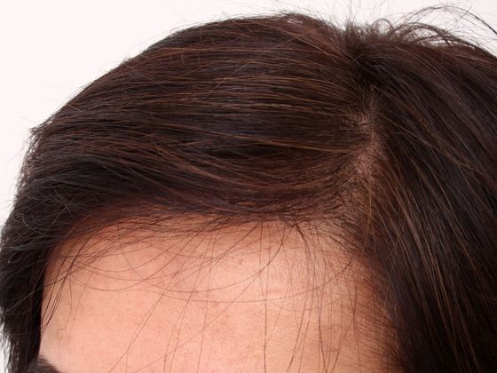 Hair Transplant - Female: Hairline FUT (5) - After female hair transplant