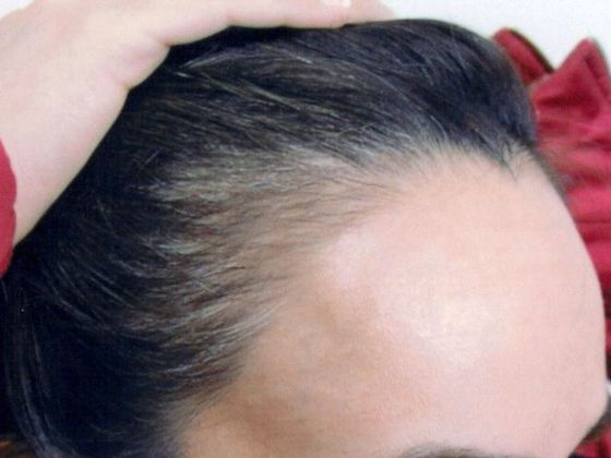 Hair Transplant - Female: Hairline FUT (5) - Before female hair transplant