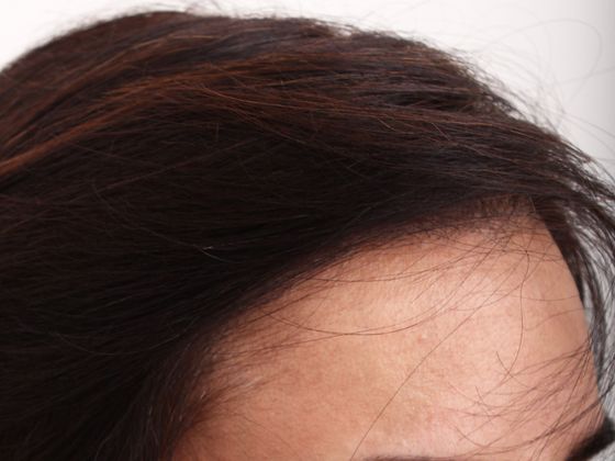 Hair Transplant - Female: Hairline FUT (5) - After female hair transplant